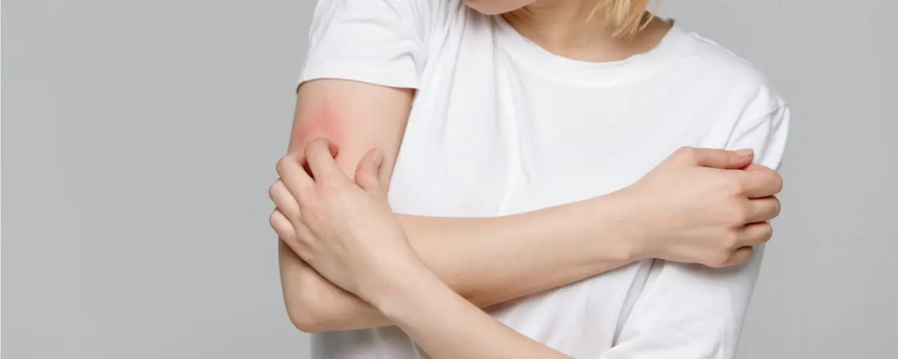 Soffri di orticaria o prurito? Ecco la pianta officinale che può darti sollievo subito